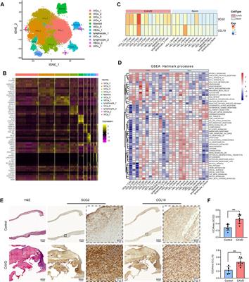 Potential biomarkers and immune cell infiltration involved in aortic valve calcification identified through integrated bioinformatics analysis